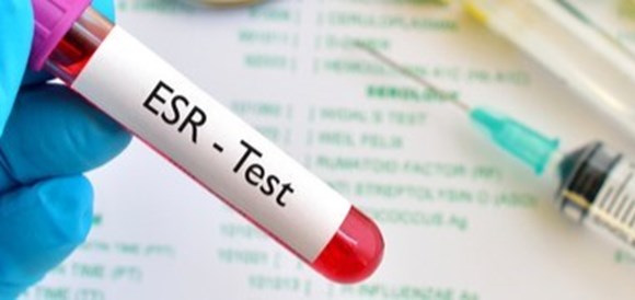 צילום: שאטרסטוק בדיקת רמות ESR בדם (Erythrocyte Sedimentation Rate) - שקיעת דם   - תמונה